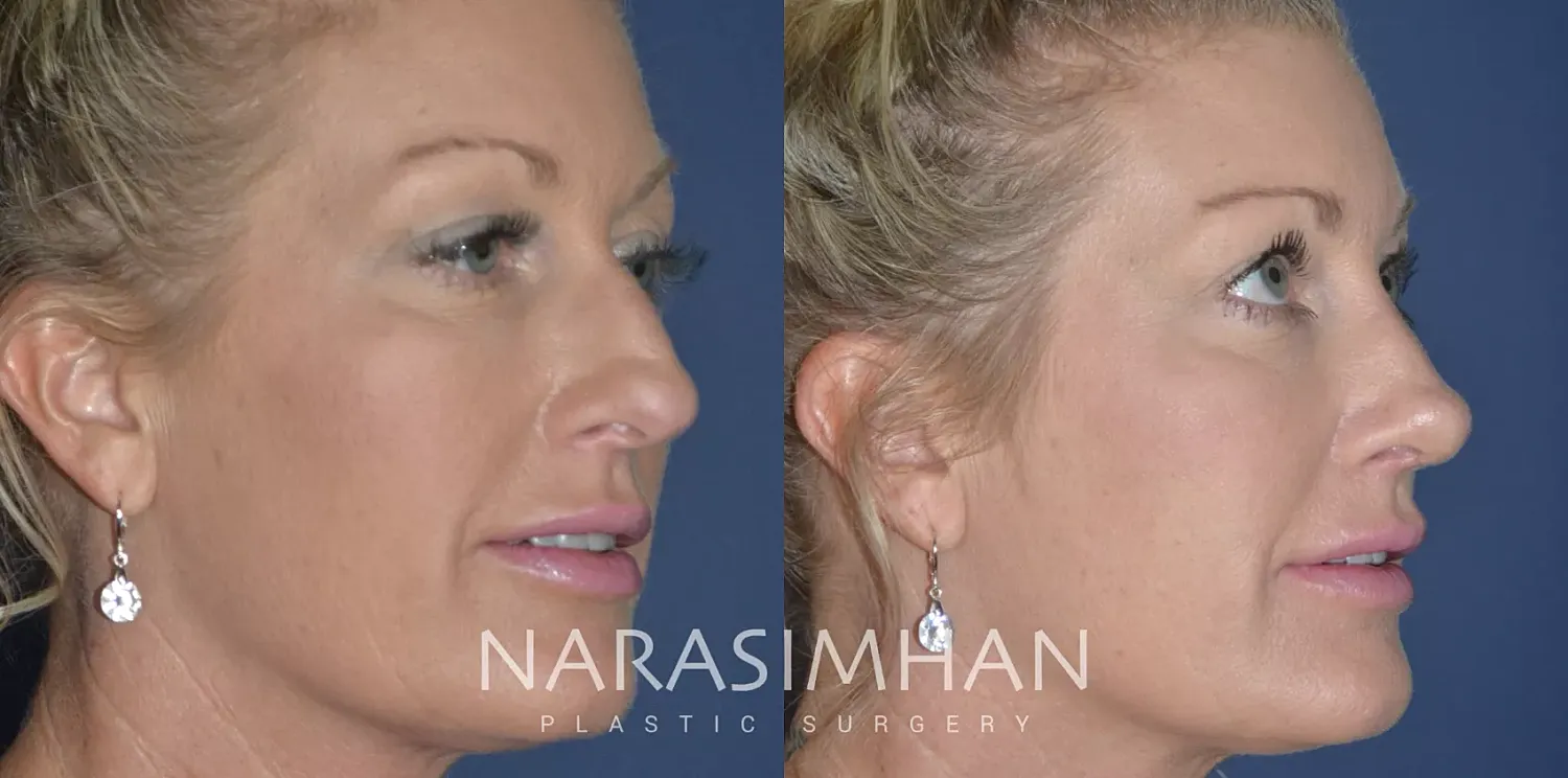 Rhinoplasty Before & After