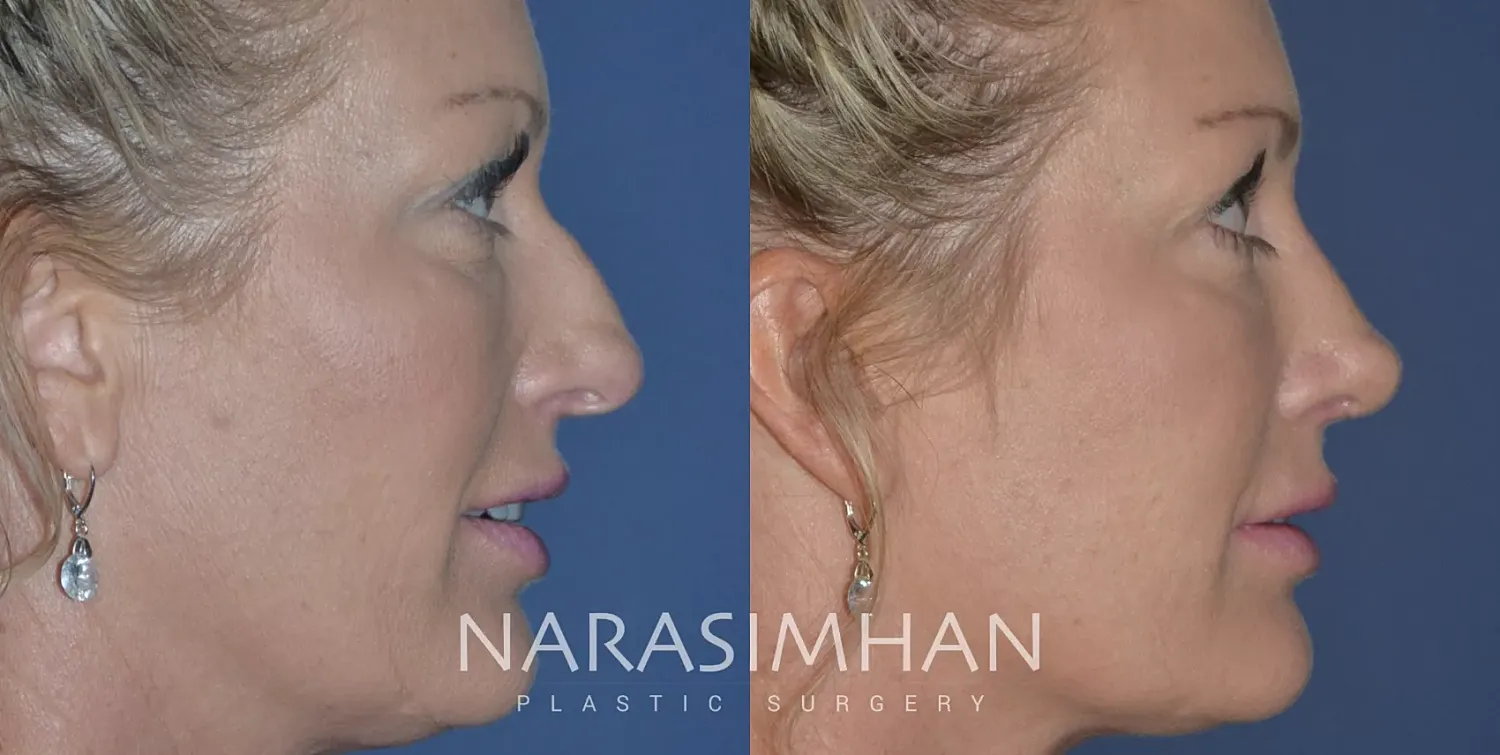 Rhinoplasty Before & After