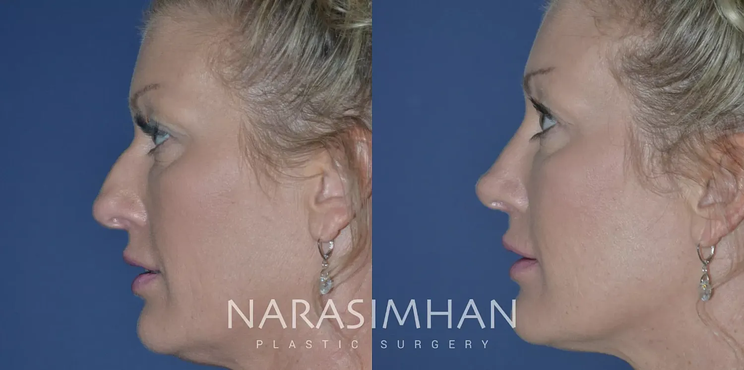 Rhinoplasty Before & After