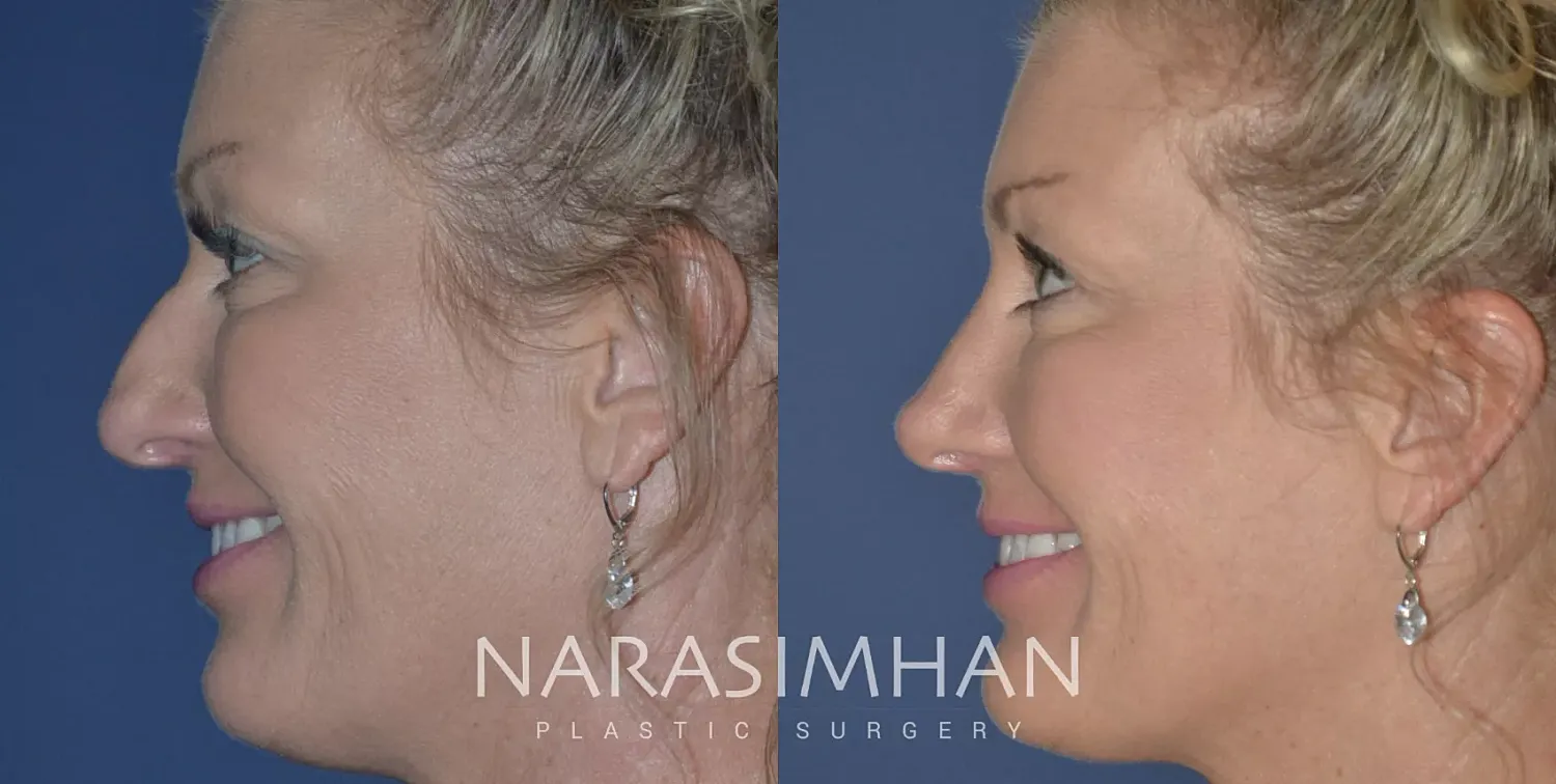 Rhinoplasty Before & After