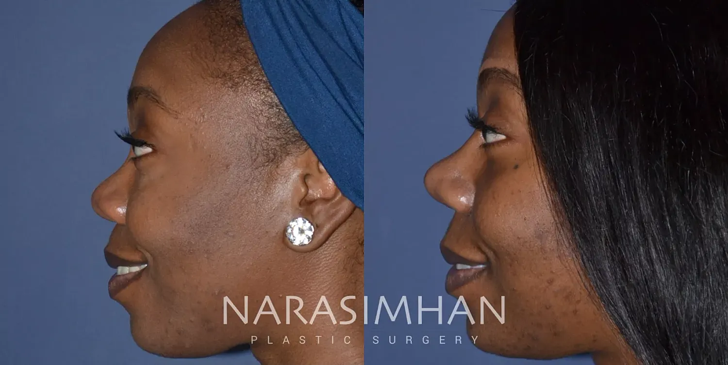 Rhinoplasty Before & After