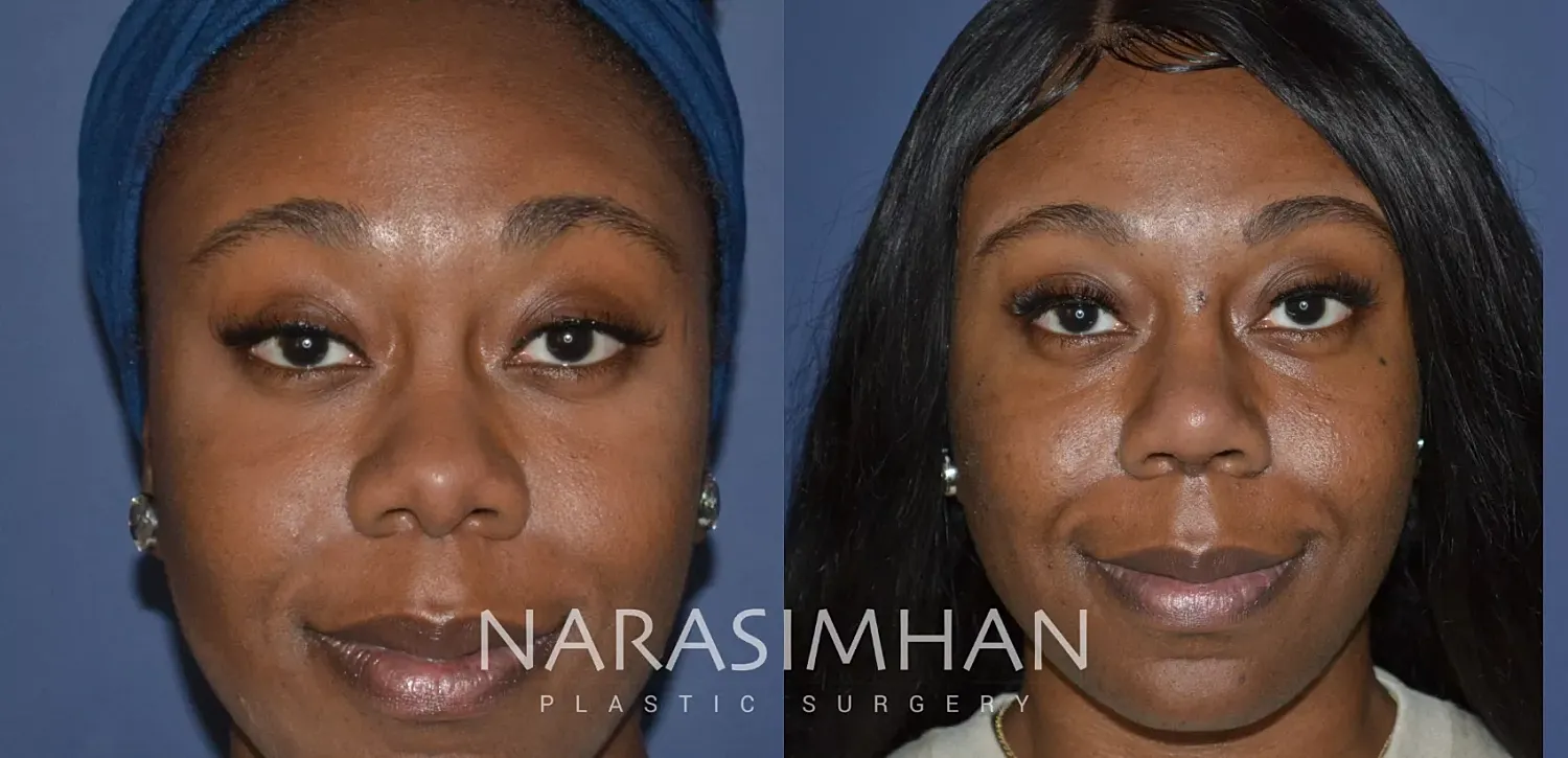 Rhinoplasty Before & After