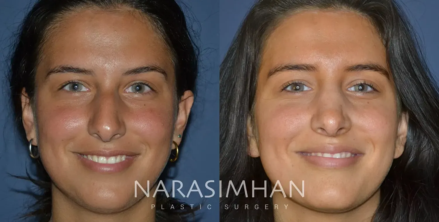 Rhinoplasty Before & After