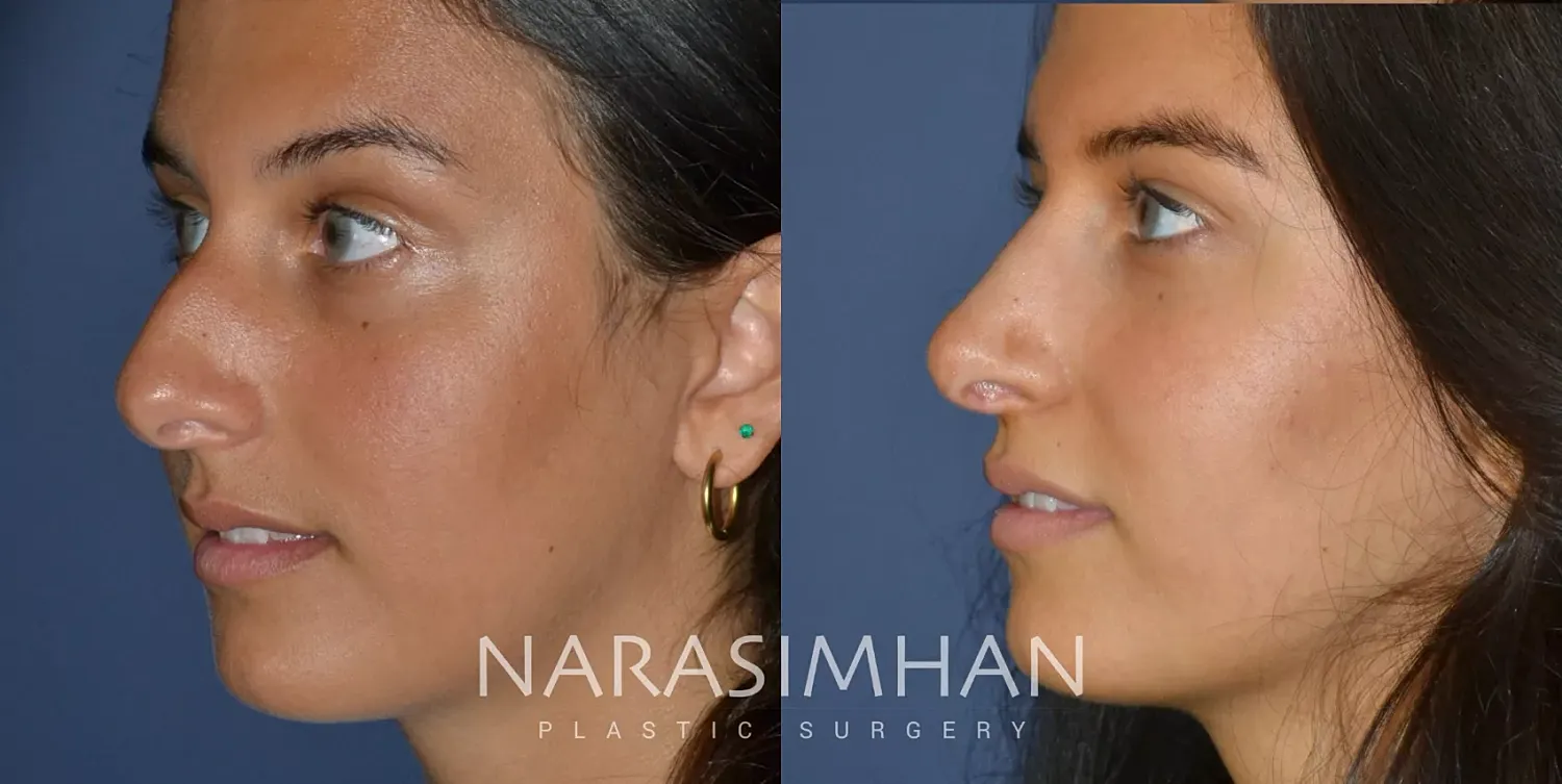 Rhinoplasty Before & After