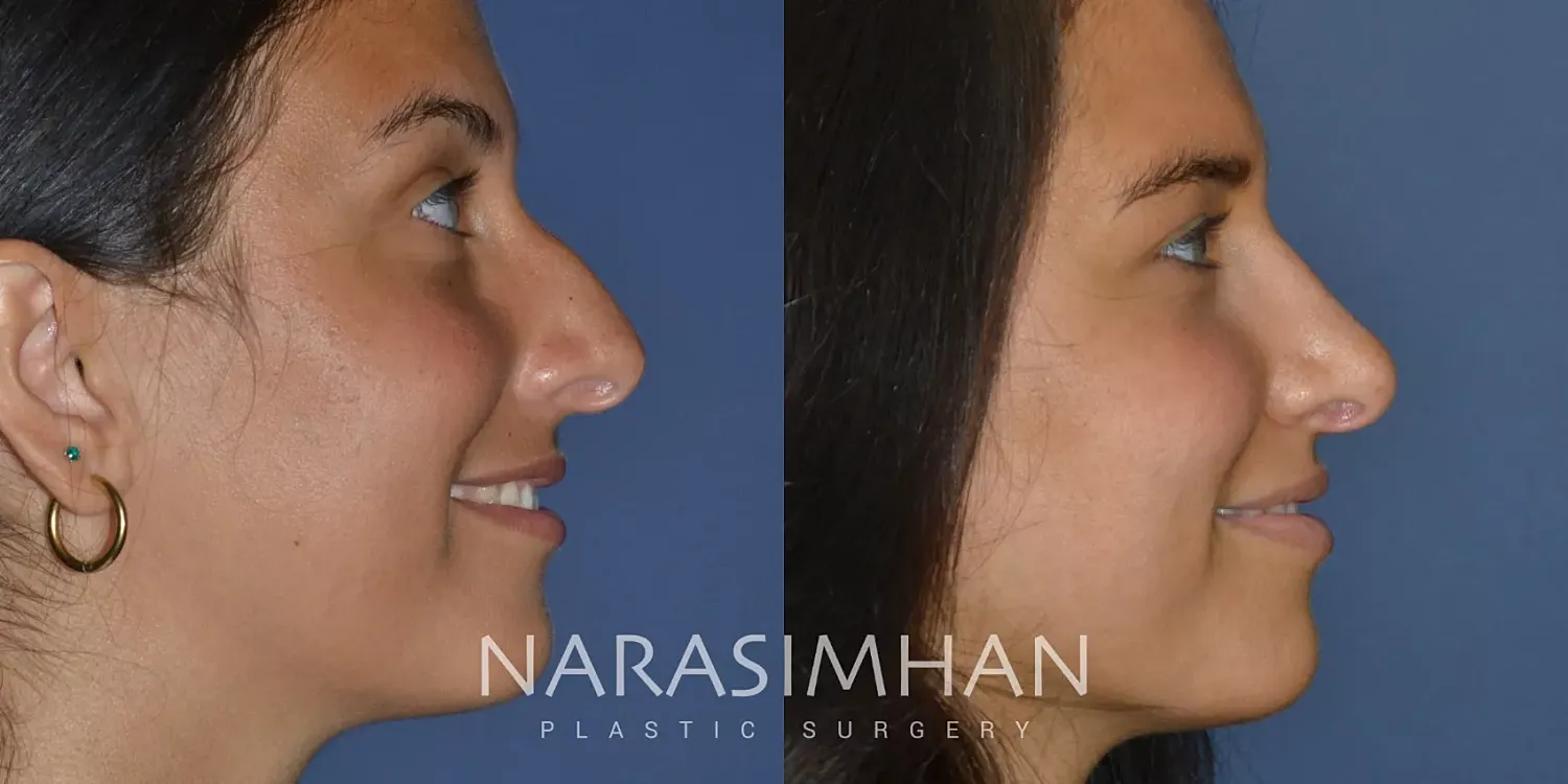 Rhinoplasty Before & After