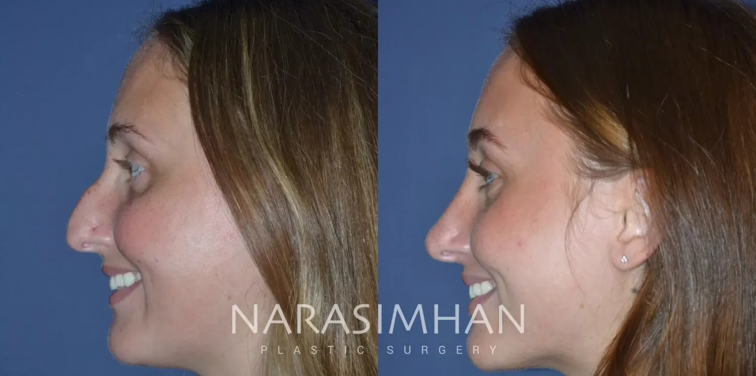 Rhinoplasty Before & After