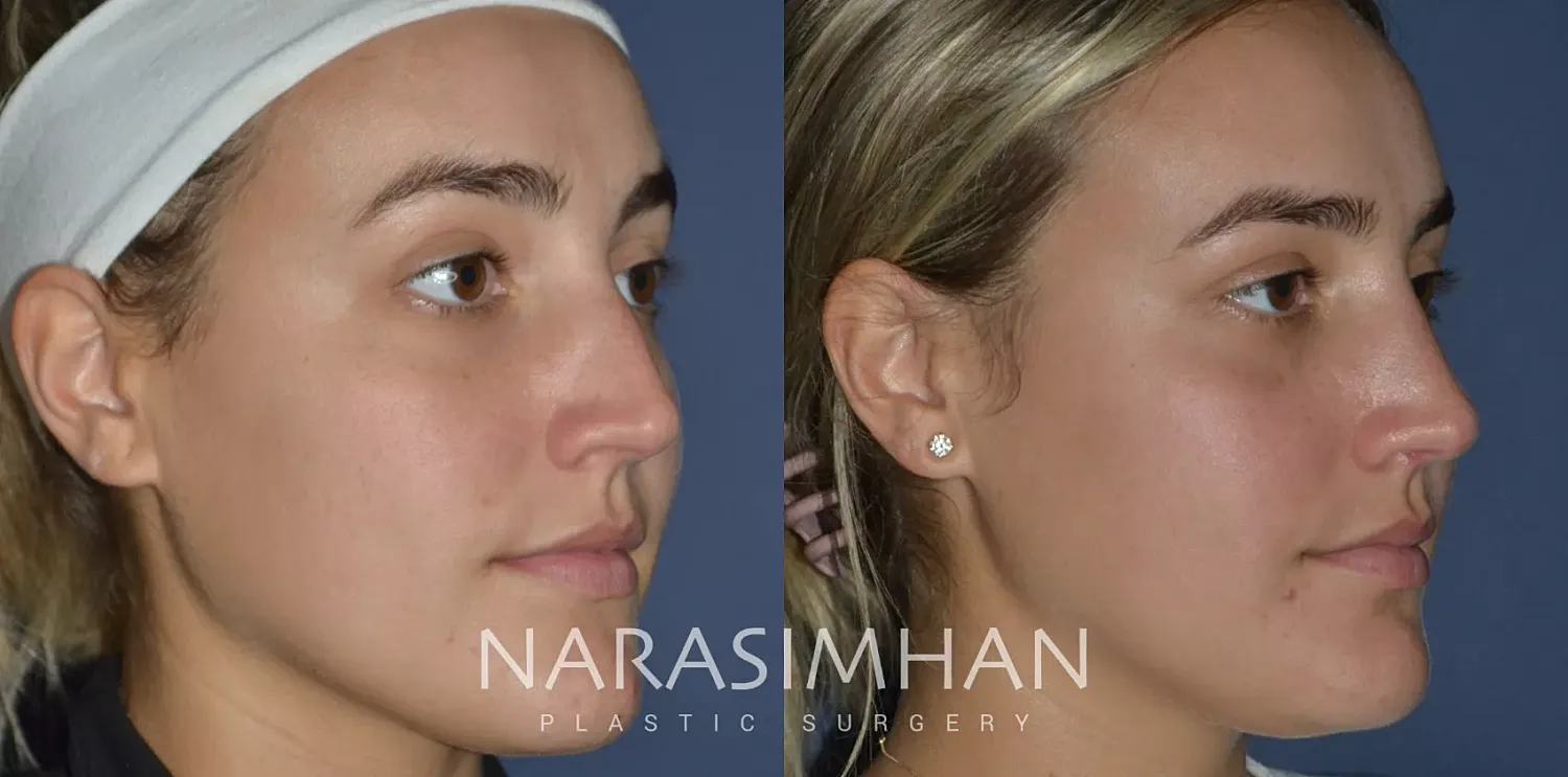 Rhinoplasty Before & After