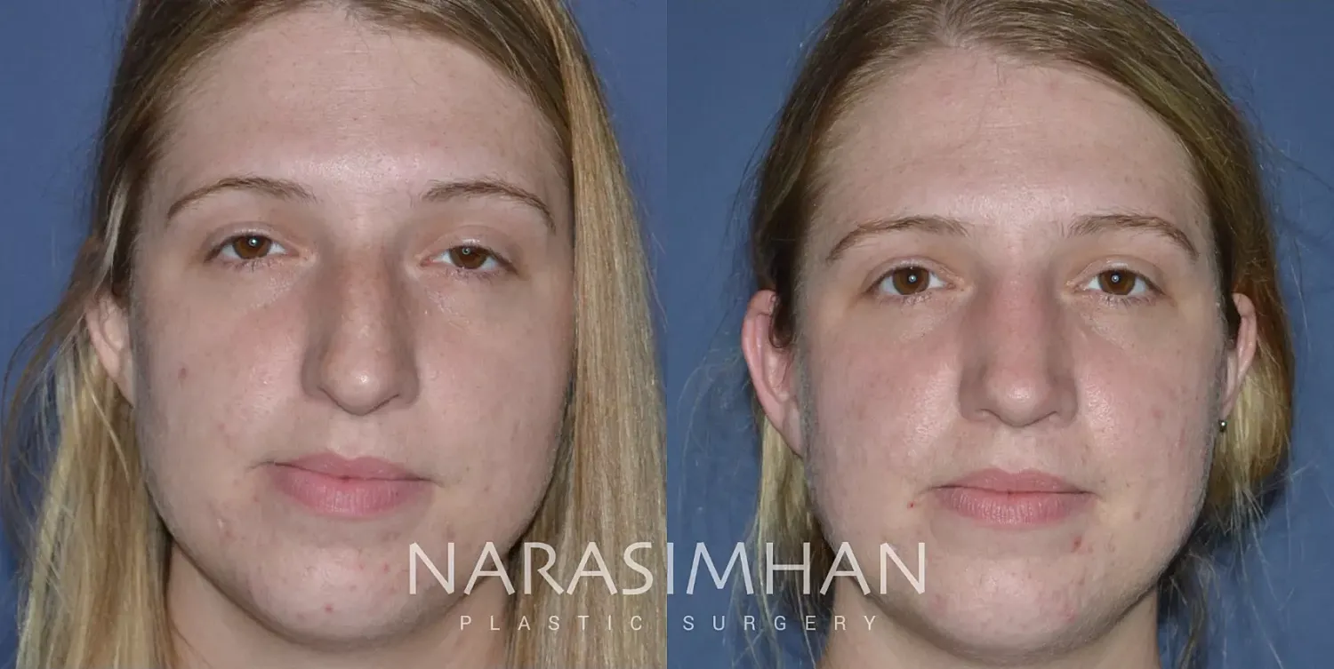 Rhinoplasty Before & After