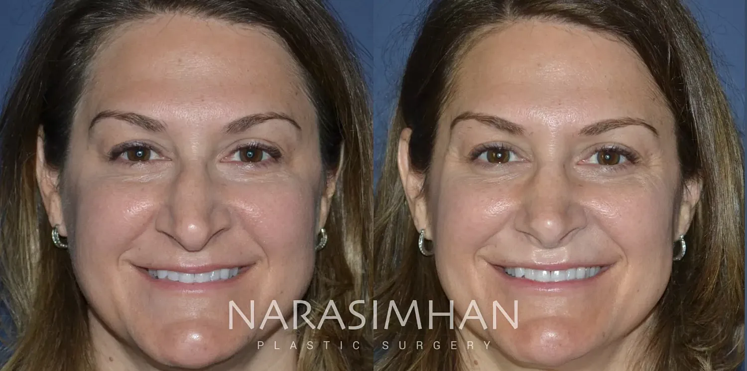 Rhinoplasty Before & After