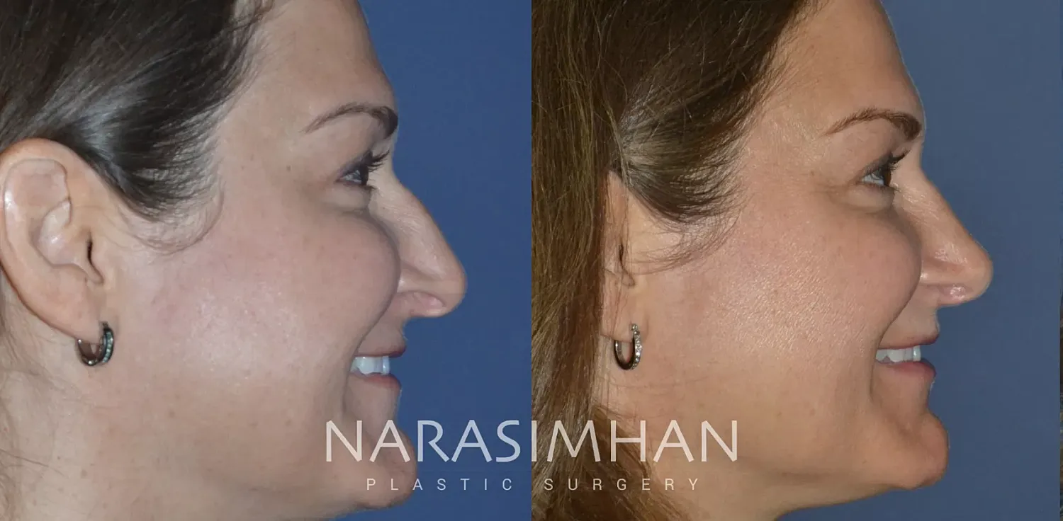 Rhinoplasty Before & After