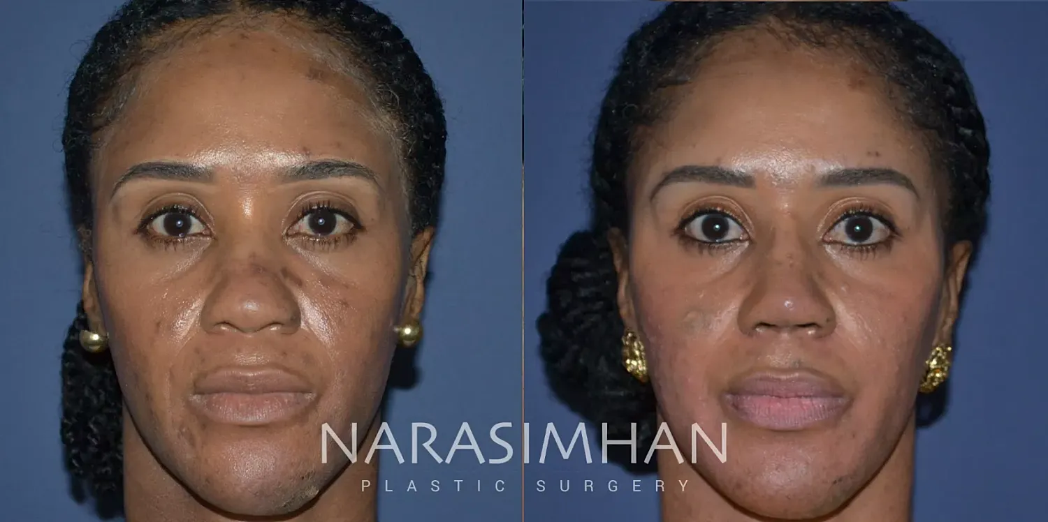 Rhinoplasty Before & After