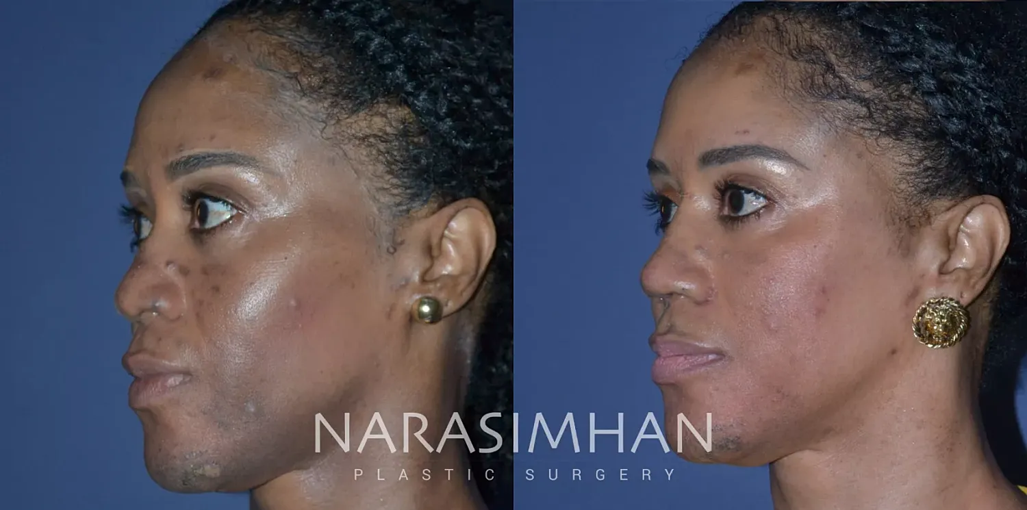 Rhinoplasty Before & After
