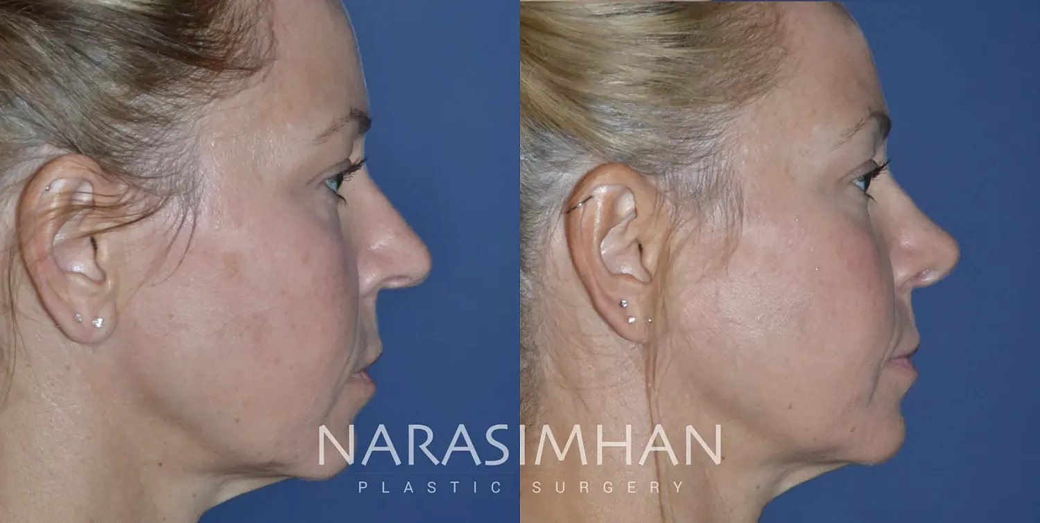 Rhinoplasty Before & After