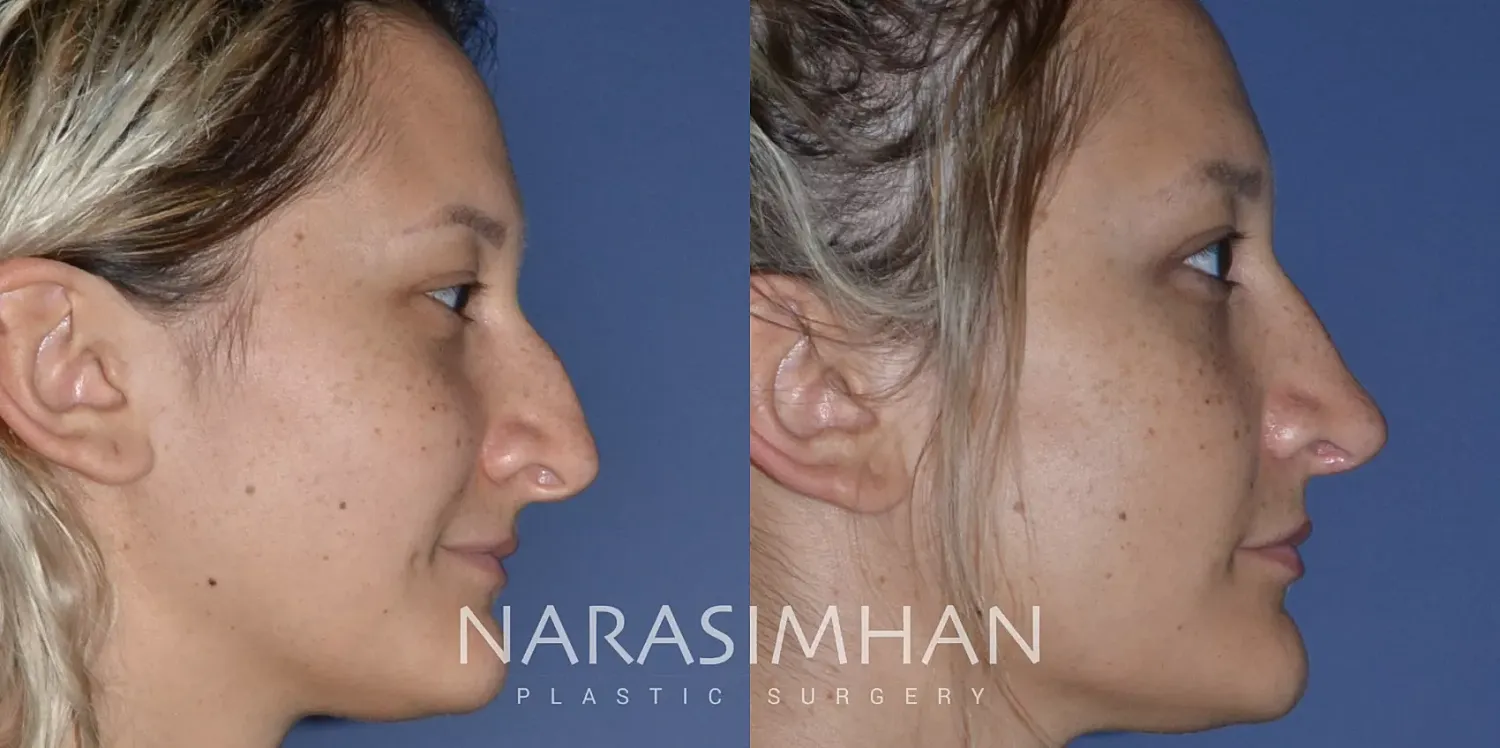 Rhinoplasty Before & After