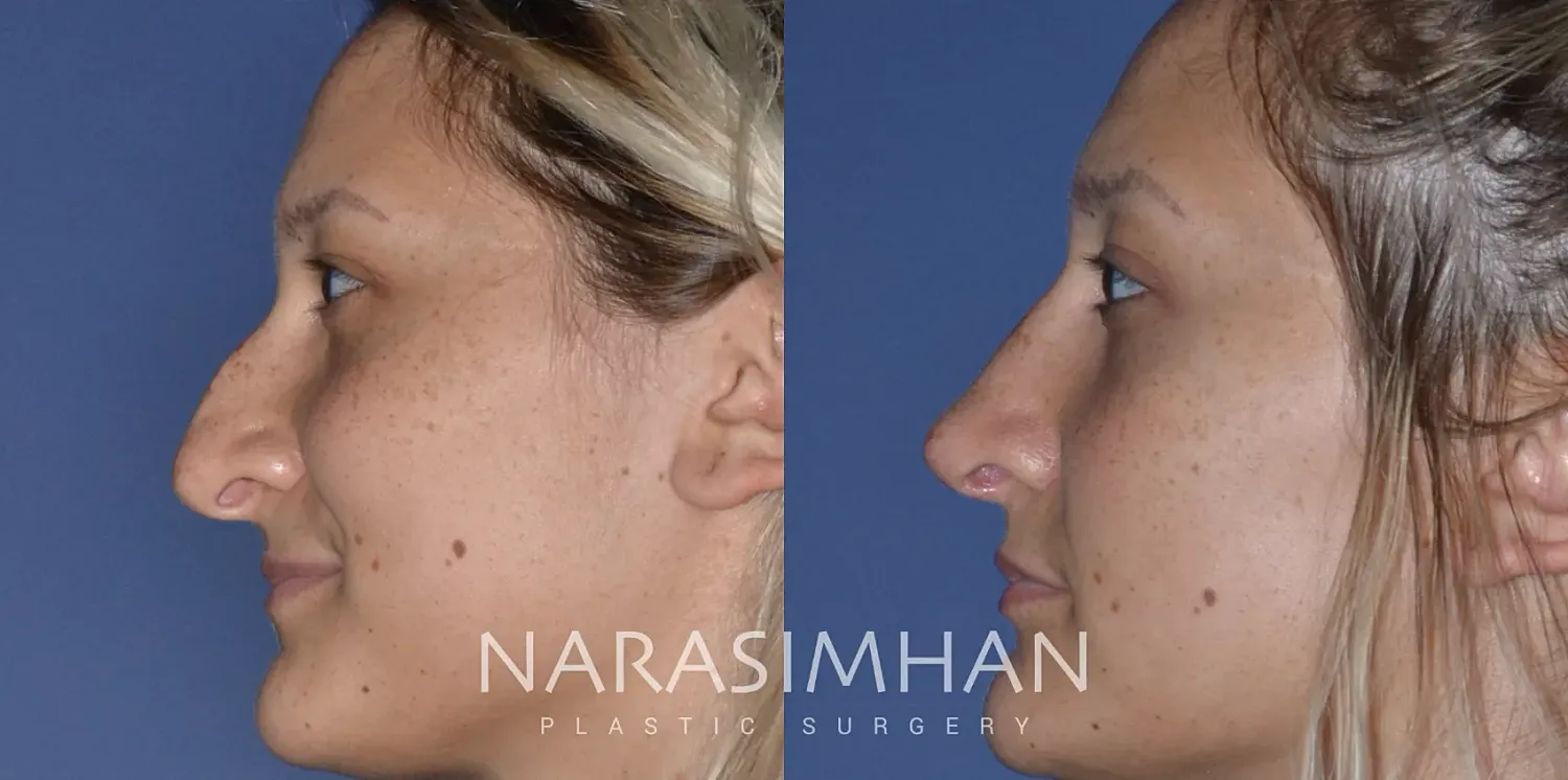 Rhinoplasty Before & After