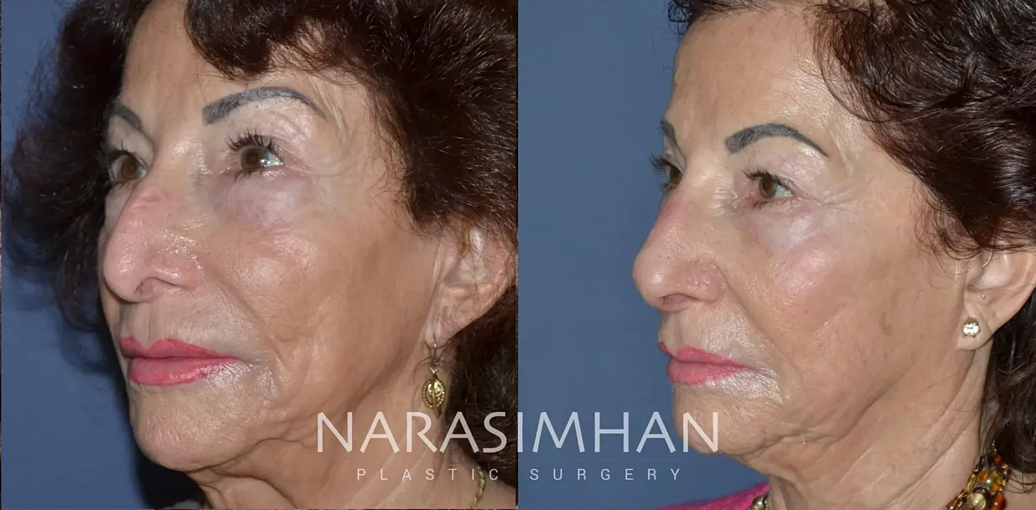 Rhinoplasty Before & After
