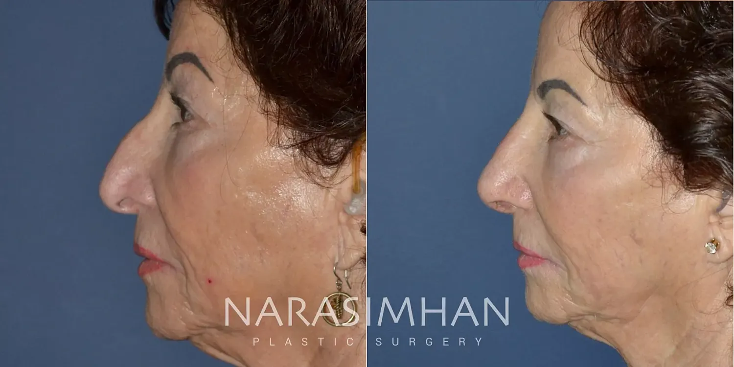 Rhinoplasty Before & After