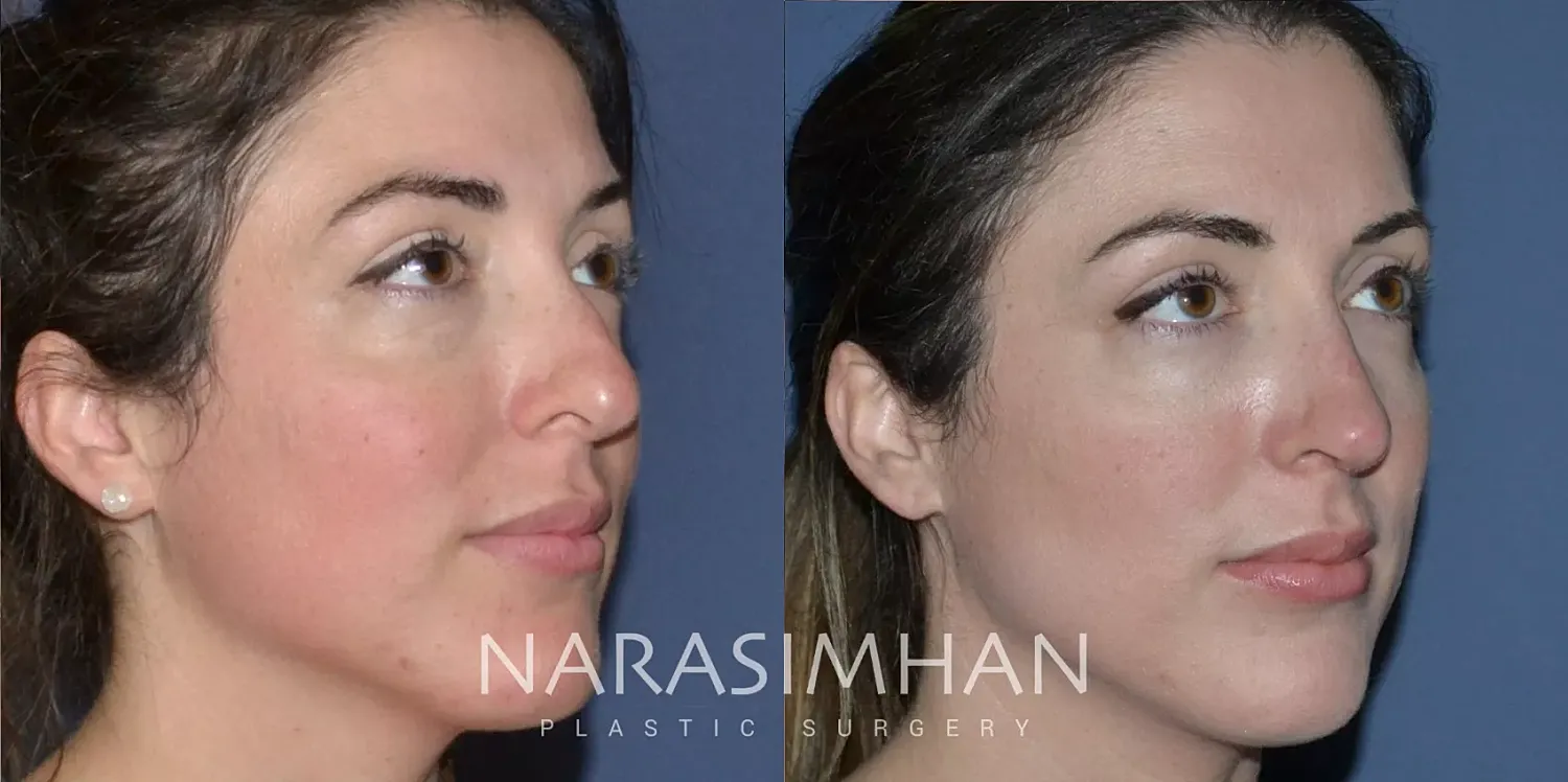 Rhinoplasty Before & After