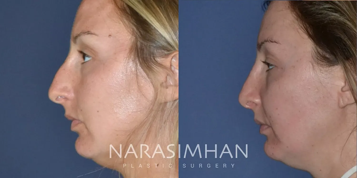 Rhinoplasty Before & After