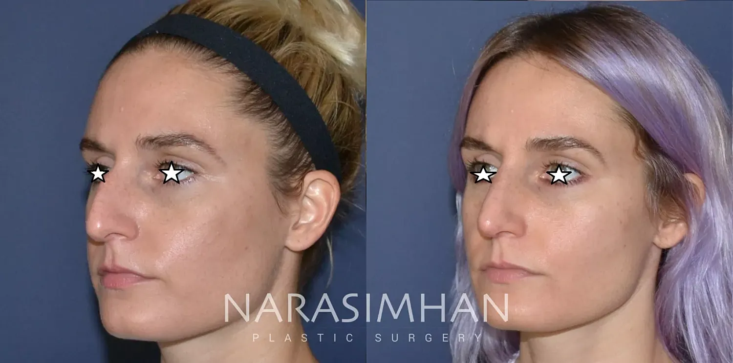 Rhinoplasty Before & After