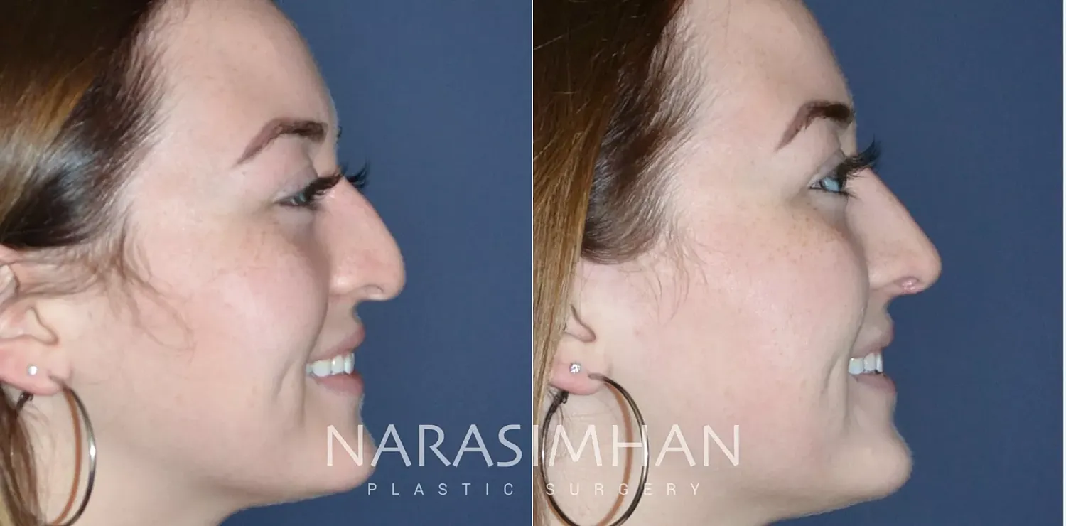 Rhinoplasty Before & After