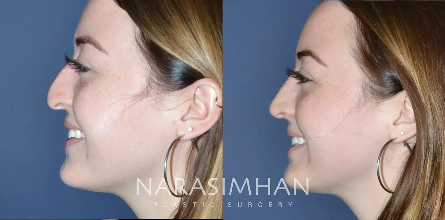 Rhinoplasty Before & After
