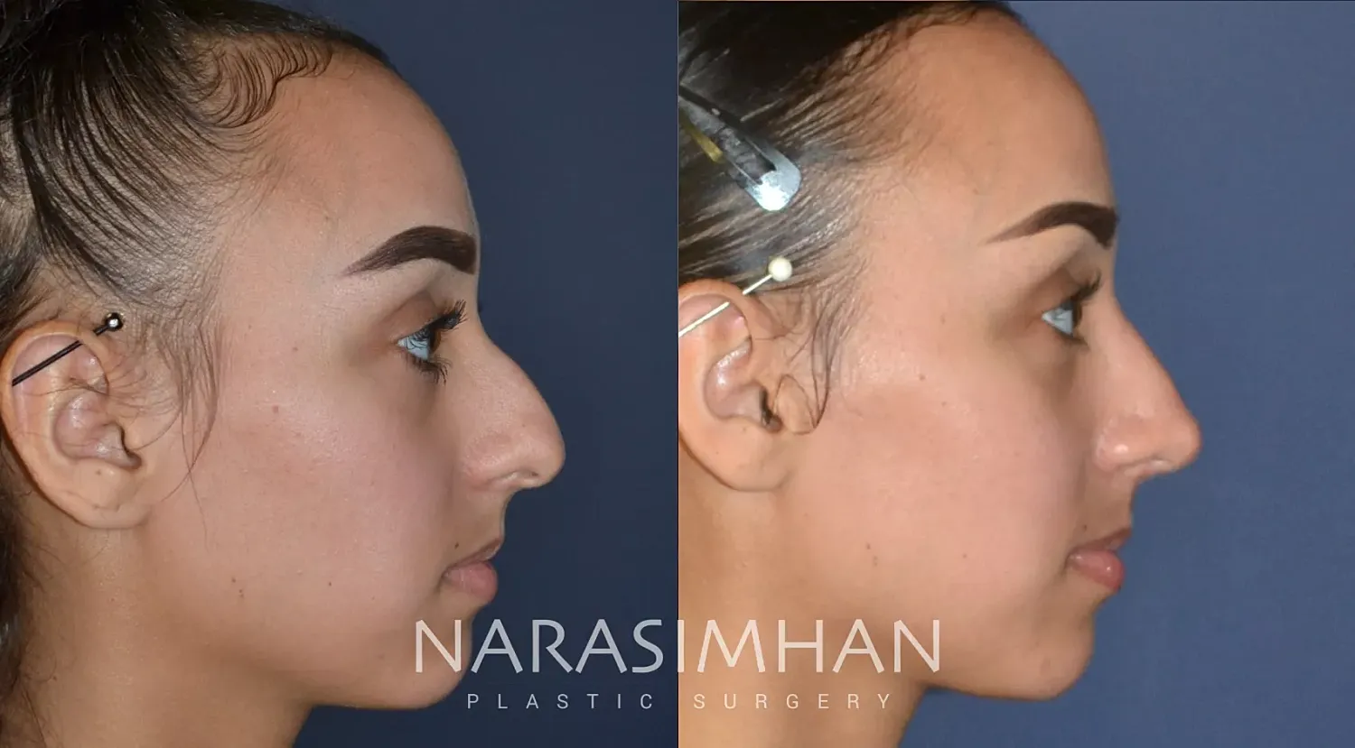 Rhinoplasty Before & After
