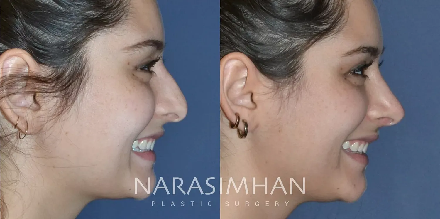 Rhinoplasty Before & After