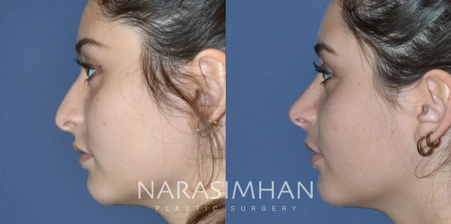 Rhinoplasty Before & After