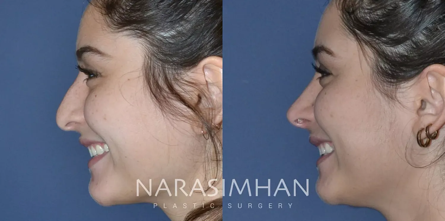 Rhinoplasty Before & After