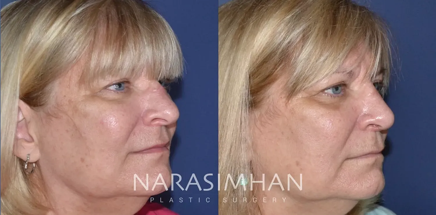 Rhinoplasty Before & After