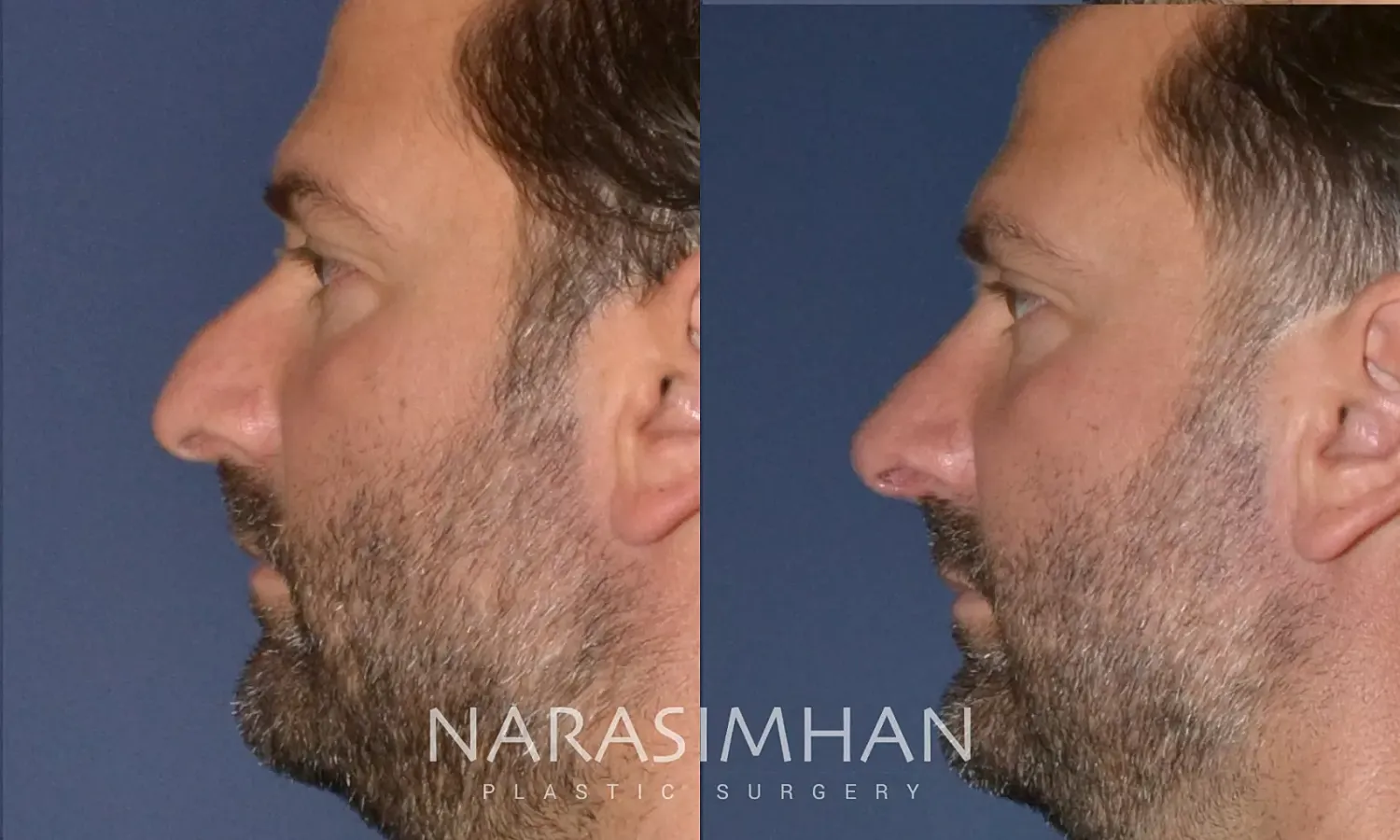 Rhinoplasty Before & After