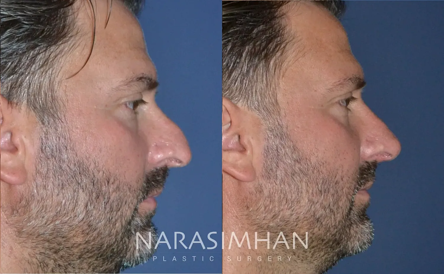 Rhinoplasty Before & After