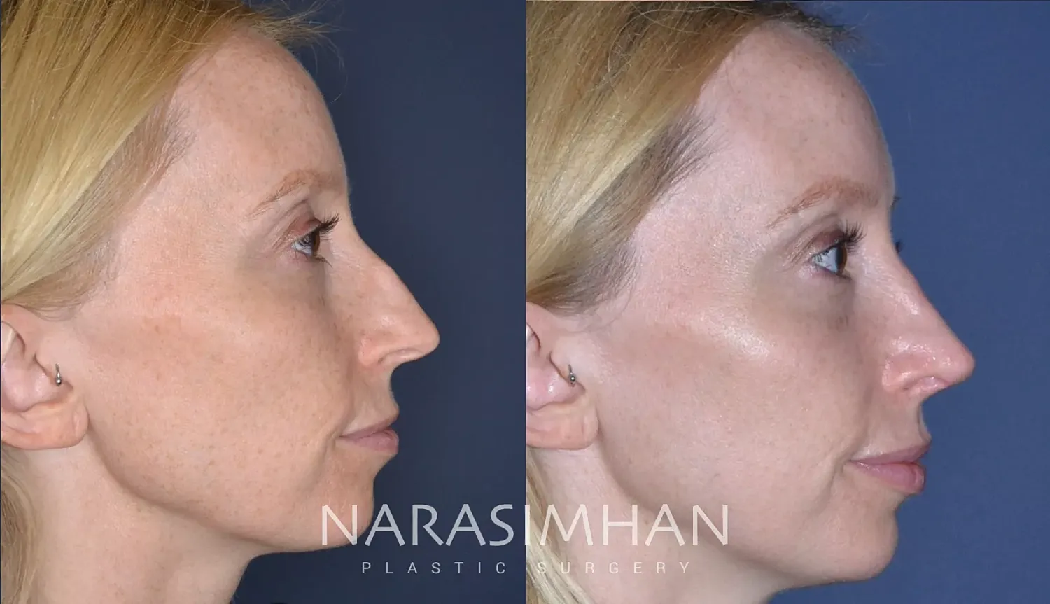 Rhinoplasty Before & After