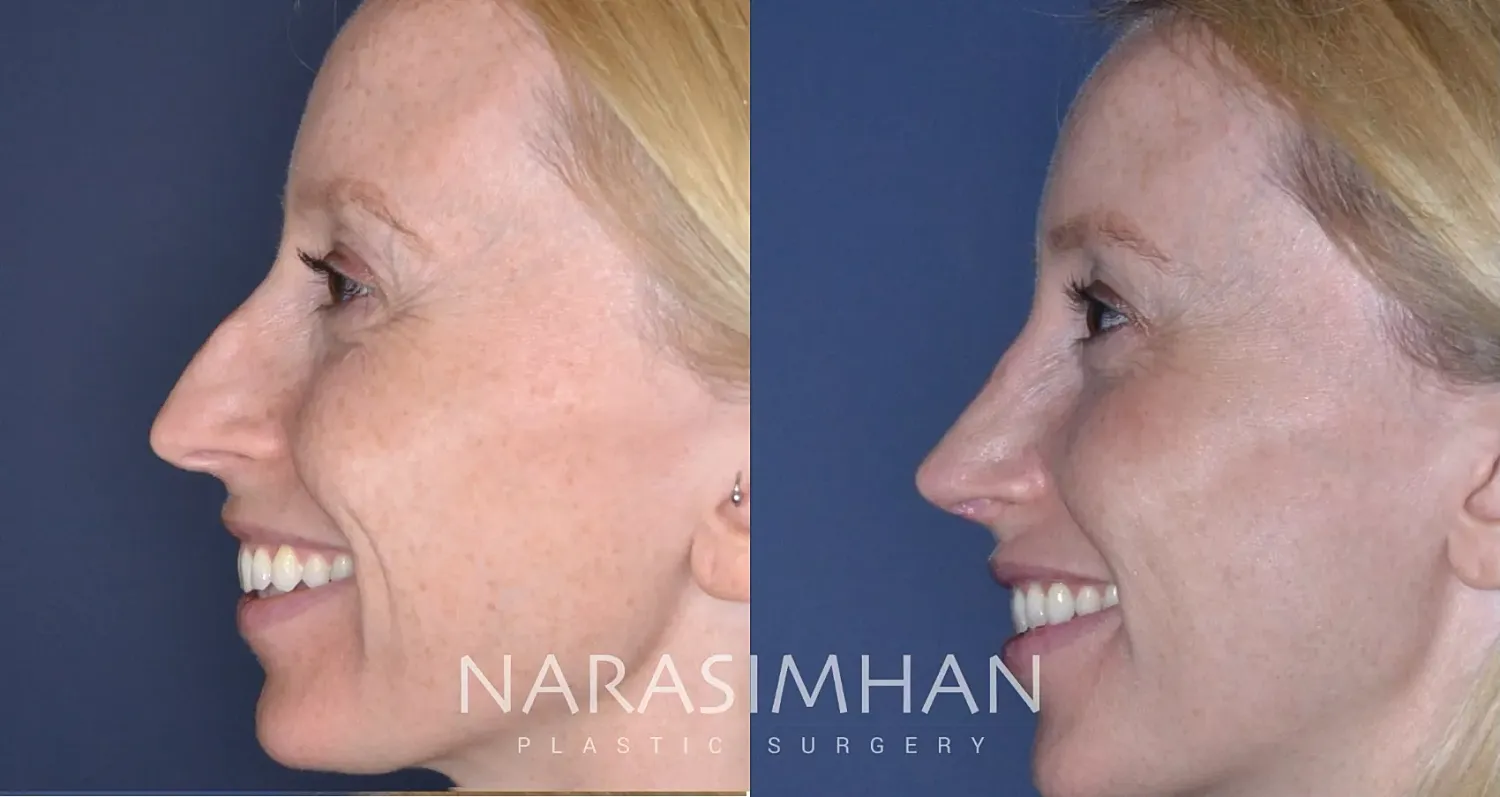 Rhinoplasty Before & After