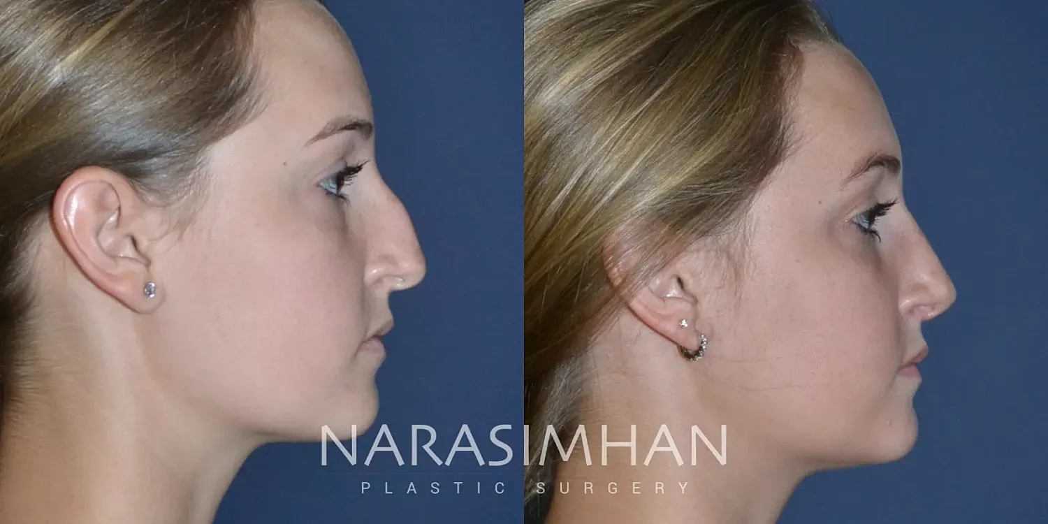 Rhinoplasty Before & After