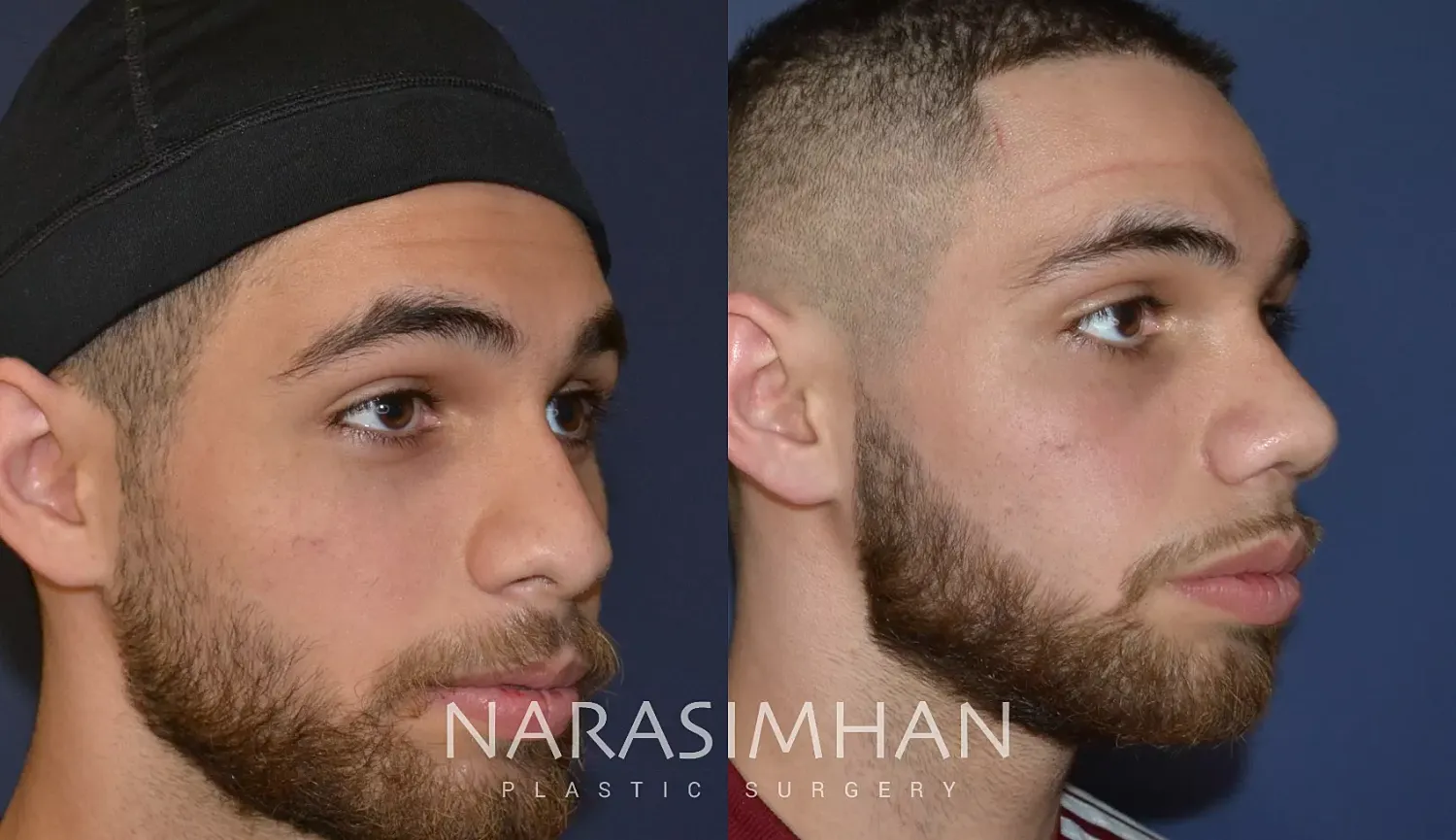 Rhinoplasty Before & After