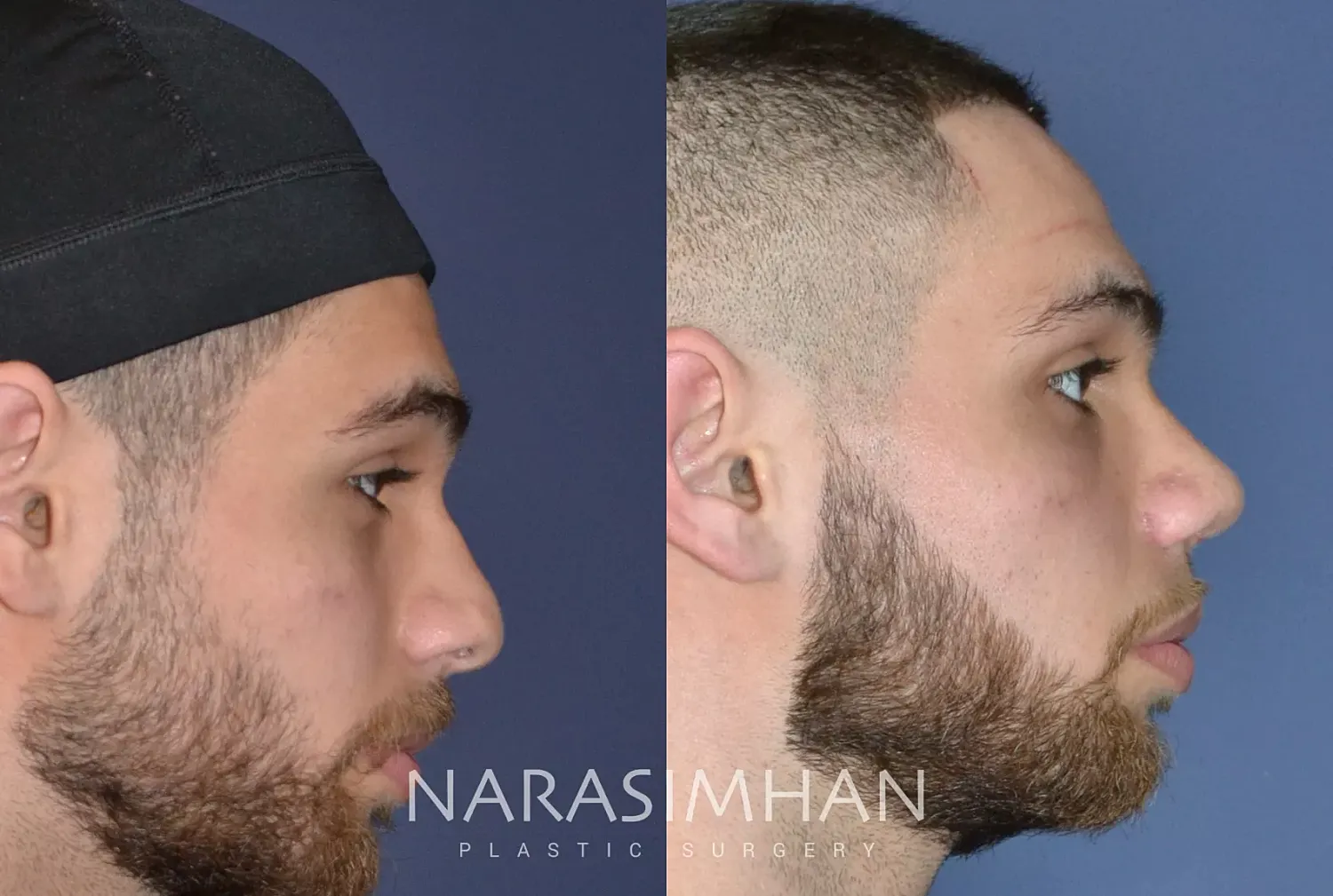 Rhinoplasty Before & After