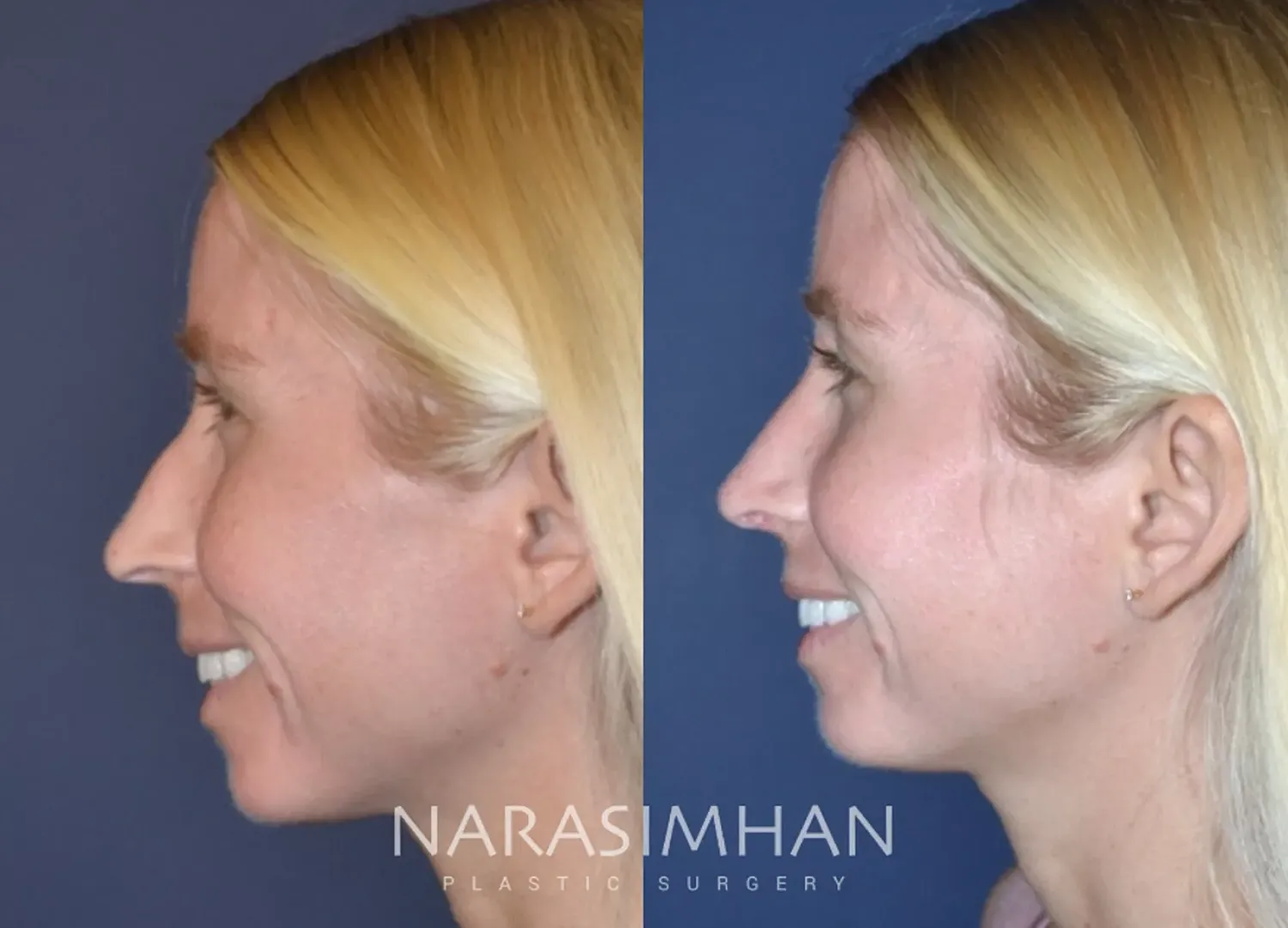Rhinoplasty Before & After