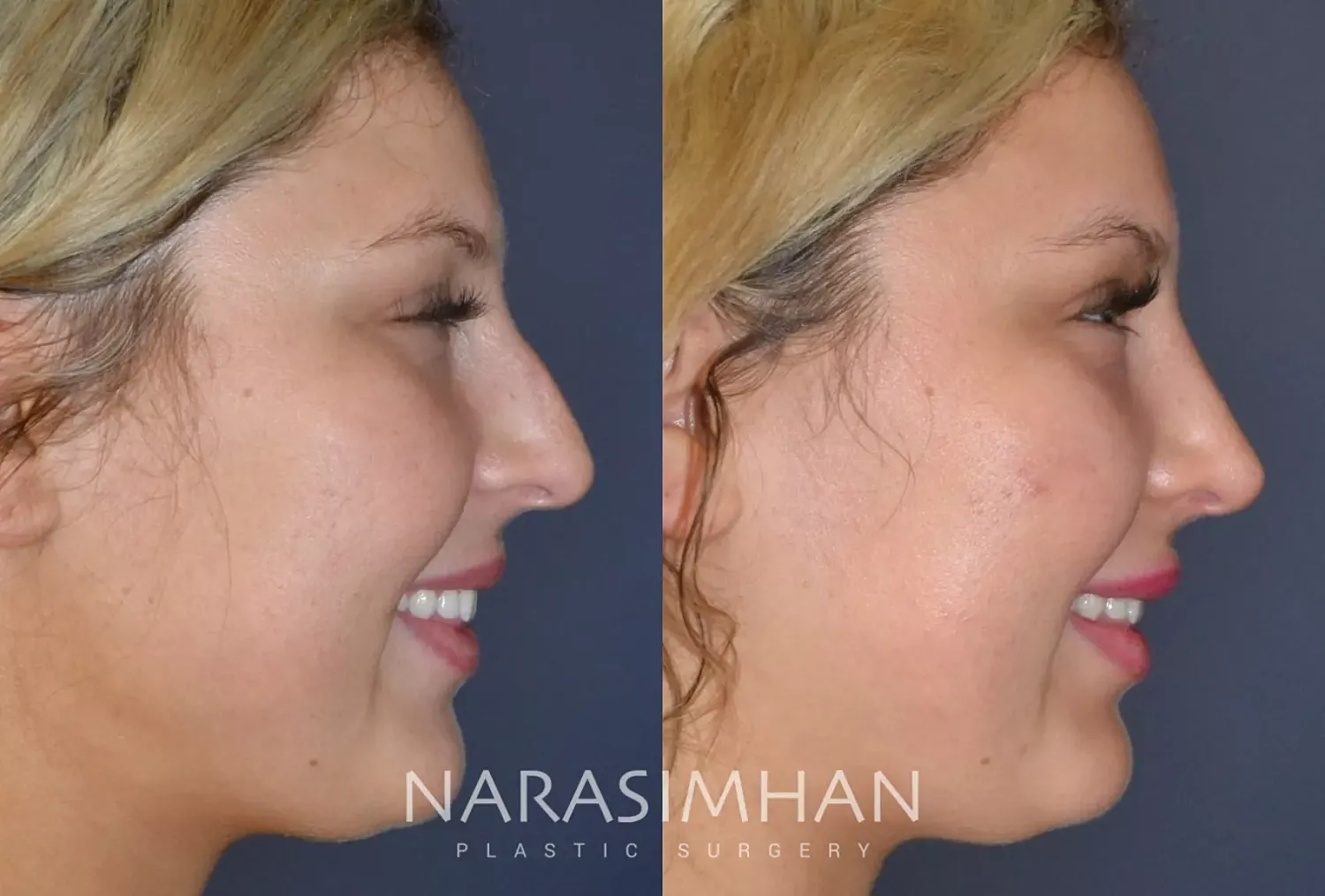 Rhinoplasty Before & After
