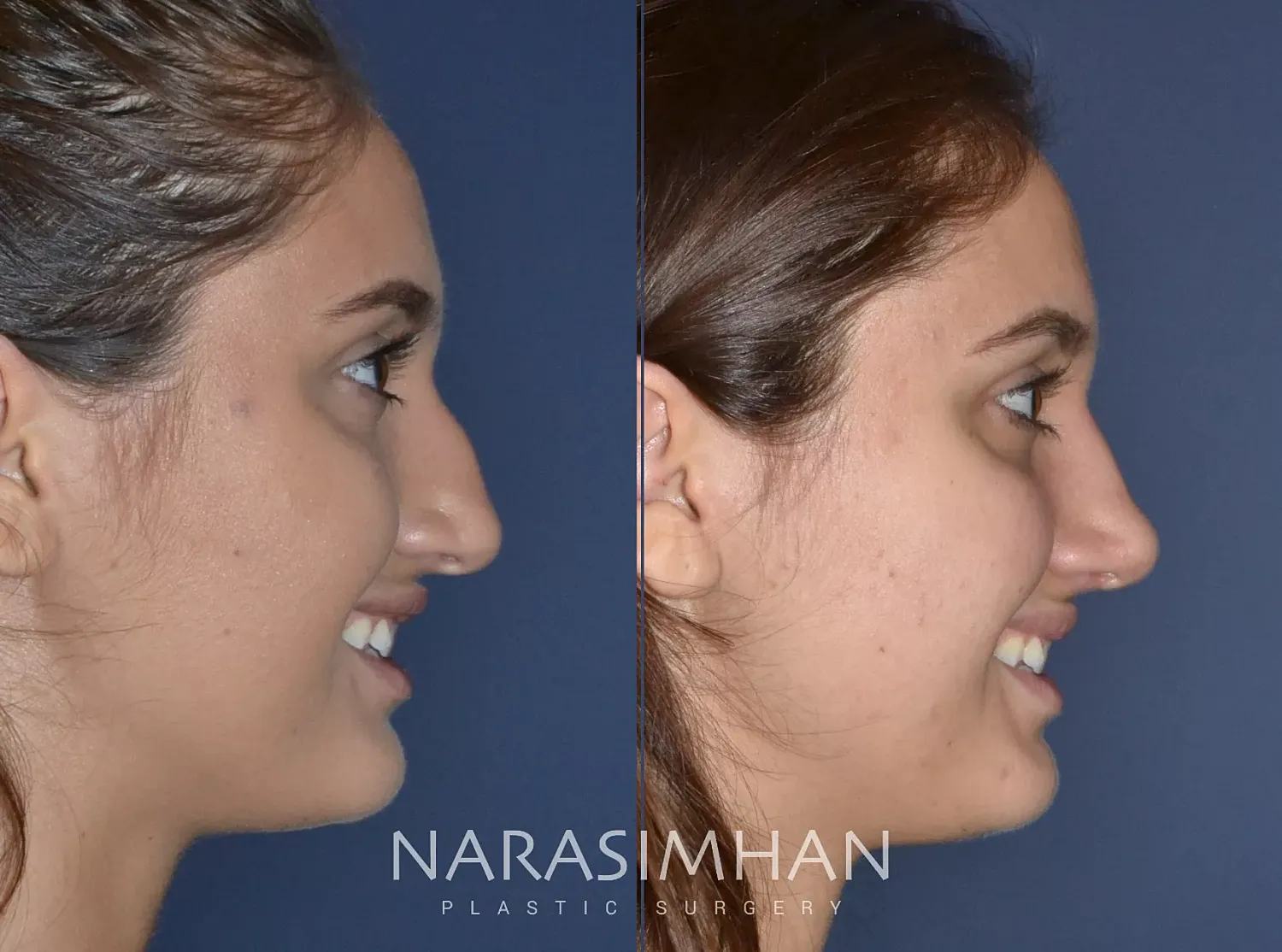 Rhinoplasty Before & After