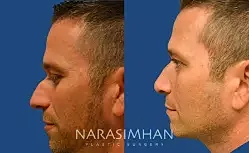 Rhinoplasty Before & After