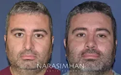 Rhinoplasty Before & After