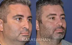 Rhinoplasty Before & After