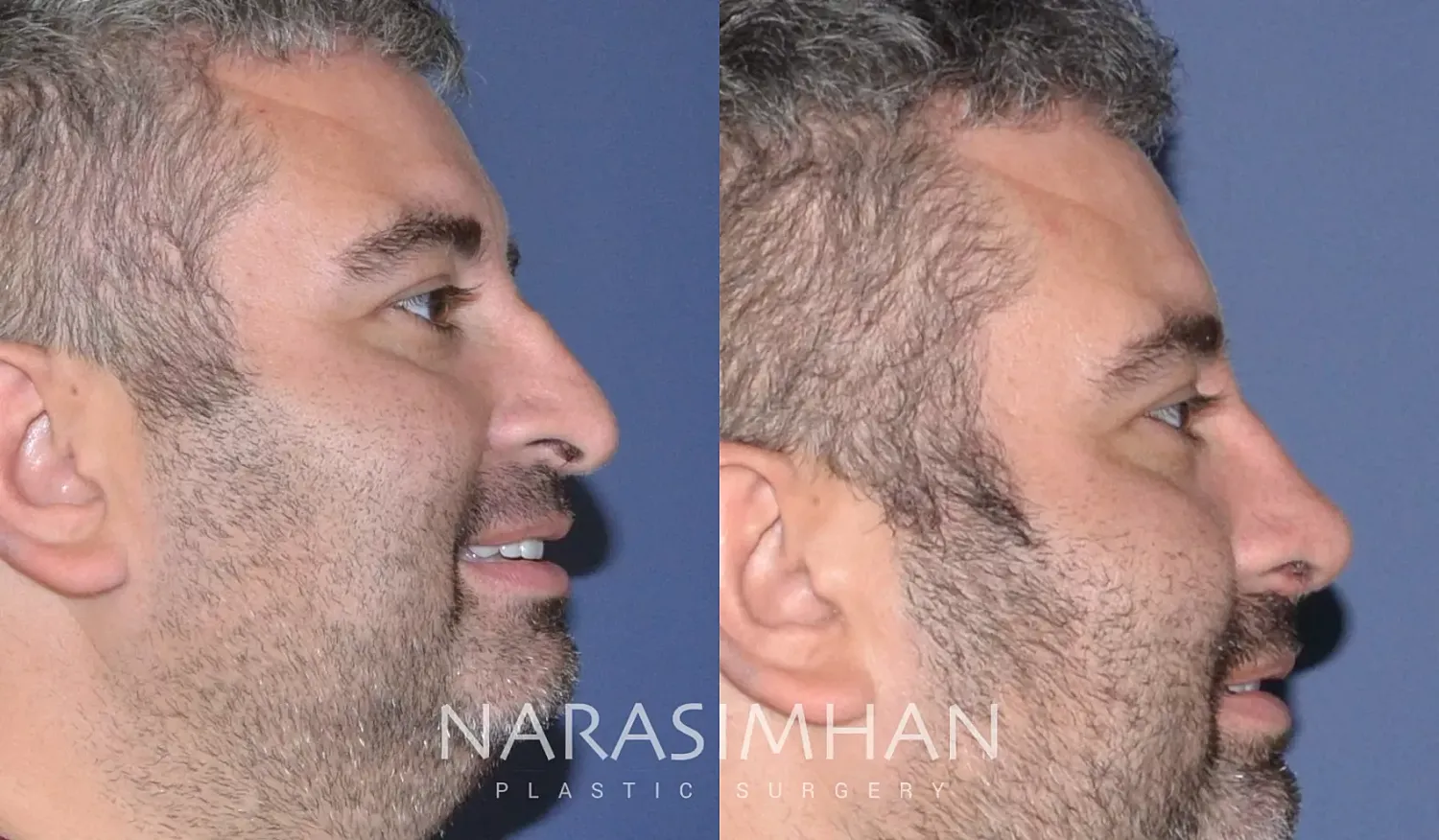 Rhinoplasty Before & After