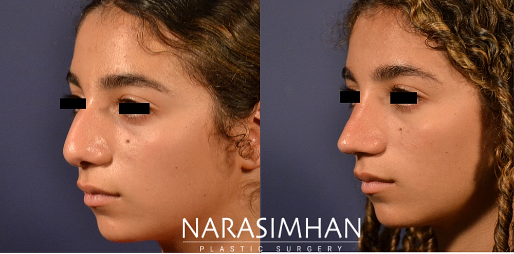 Rhinoplasty Before & After
