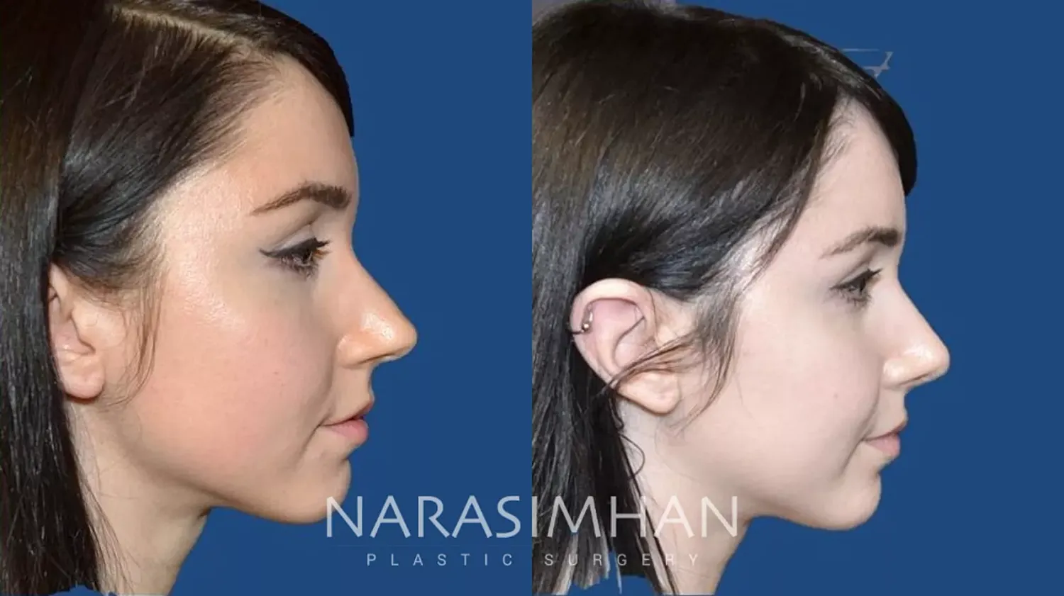 Rhinoplasty Before & After