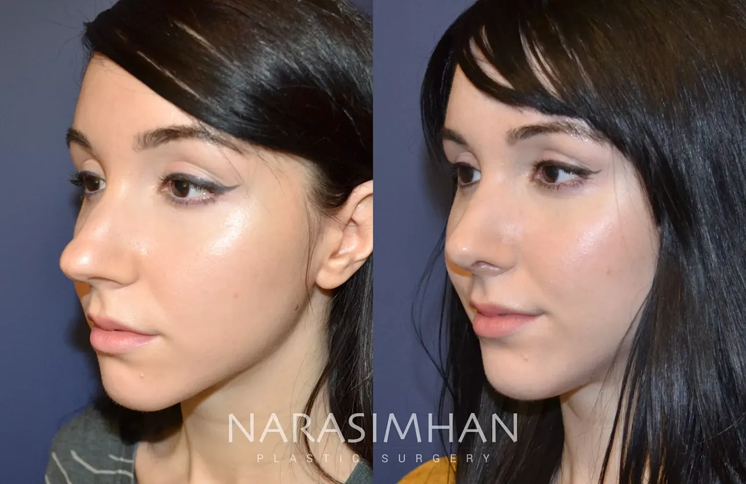 Rhinoplasty Before & After