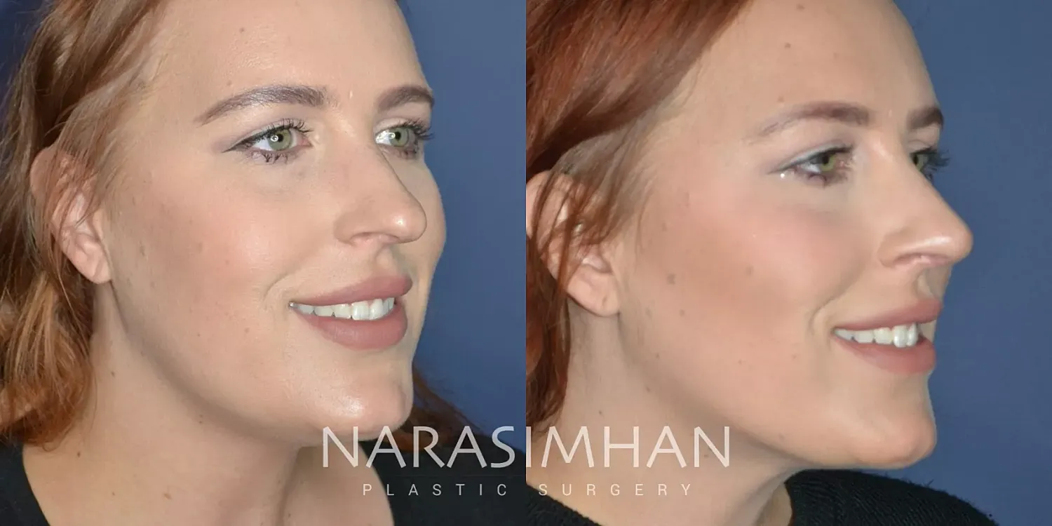 Rhinoplasty Before & After
