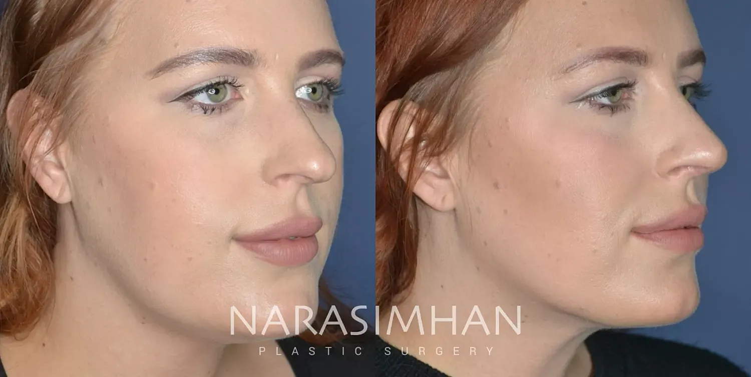 Rhinoplasty Before & After